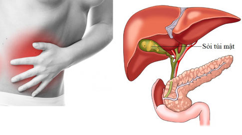 Sỏi mật ở trẻ em - Những điều cần biết 